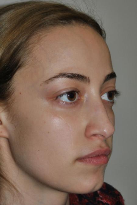 Before image 2 Case #122641 - Aesthetic Reduction Rhinoseptoplasty