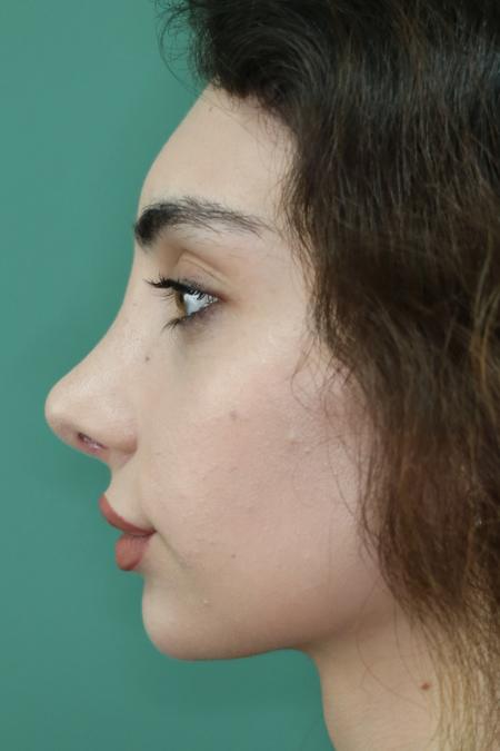 After image 4 Case #122491 - Aesthetic Reduction Rhinoseptoplasty