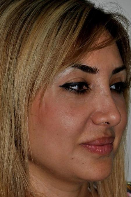 After image 2 Case #122601 - Aging Rhinoplasty