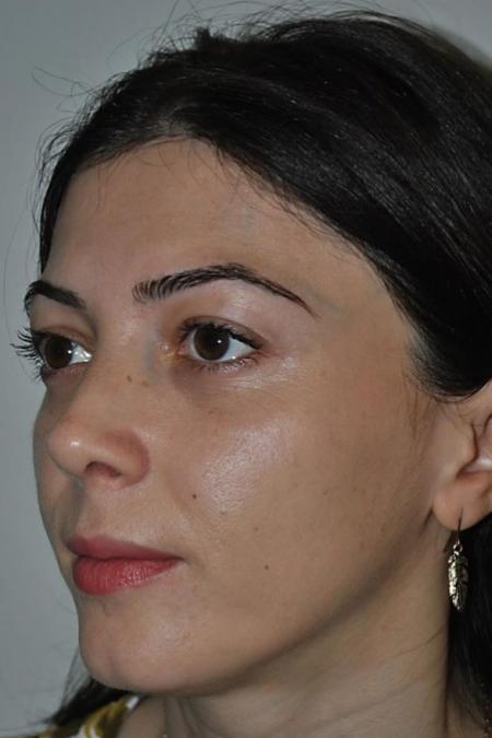 After image 3 Case #122636 - Aestetic Reduction Rhinoseptoplasty