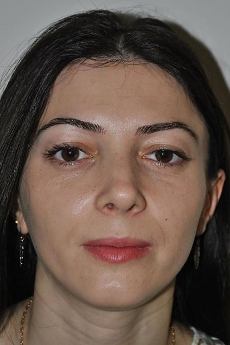 After image 1 Case #122636 - Aestetic Reduction Rhinoseptoplasty