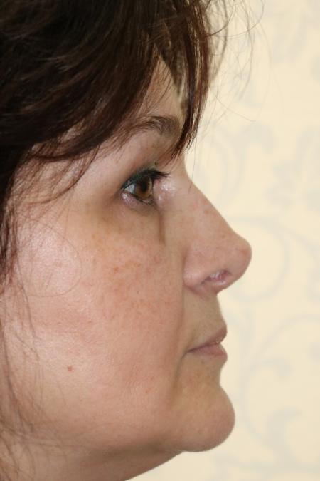 After image 5 Case #122596 - Aging Rhinoseptoplasty