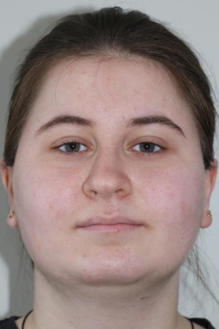 Before image 1 Case #122866 - Nasal Deviation Syndrome