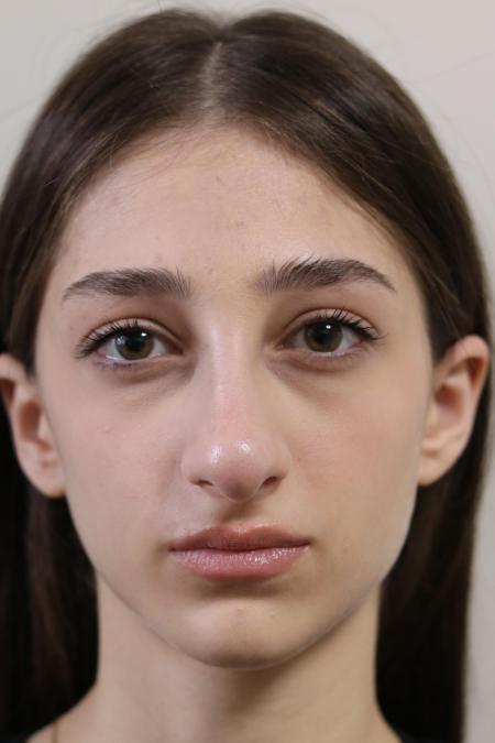 Before image 1 Case #122801 - Reduction Rhinoseptoplasty