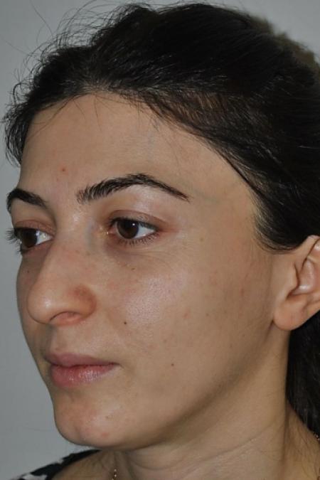 Before image 3 Case #122636 - Aestetic Reduction Rhinoseptoplasty