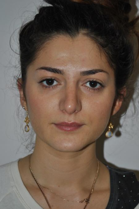 After image 1 Case #122741 - Primary Rhinoseptoplasty, Turbinate Lateralization