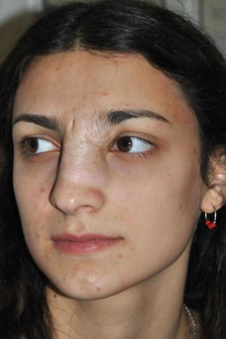 Before image 2 Case #122646 - Aestetic Reduction Rhinoplasty