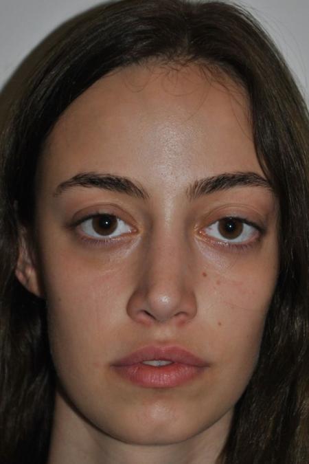 After image 1 Case #122641 - Aesthetic Reduction Rhinoseptoplasty