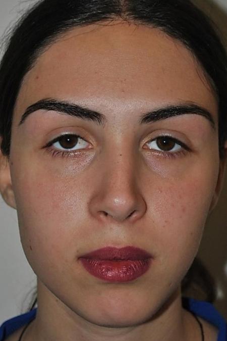 After image 1 Case #122621 - Aesthetic Reduction Rhinoseptoplasty