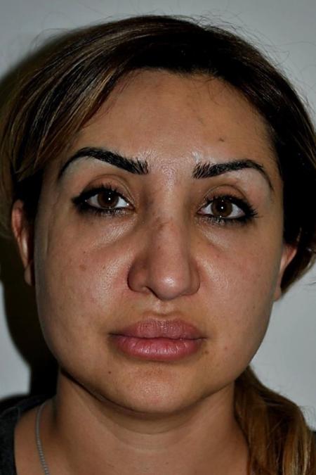 Before image 1 Case #122601 - Aging Rhinoplasty