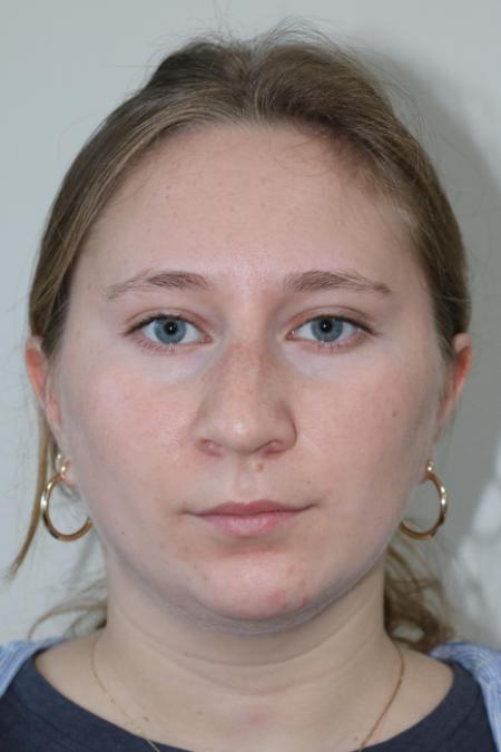 Before image 1 Case #122876 - Nasal Deviation Syndrome. Rhinogenic Headache 