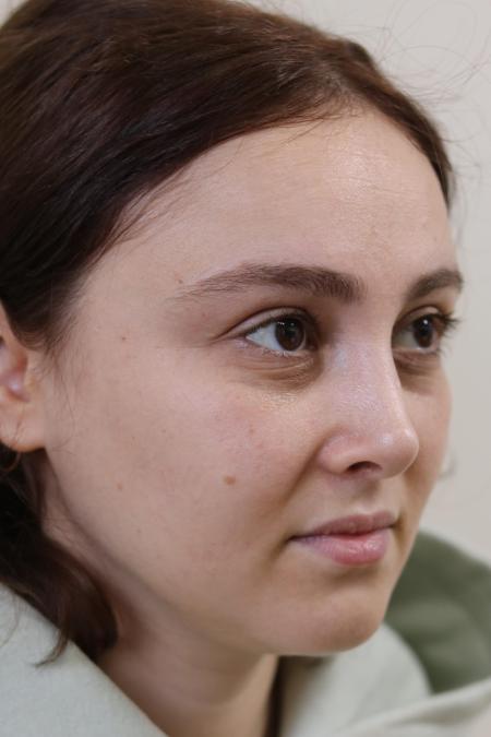 After image 3 Case #122861 - Aesthetic Reduction Rhinoplasty
