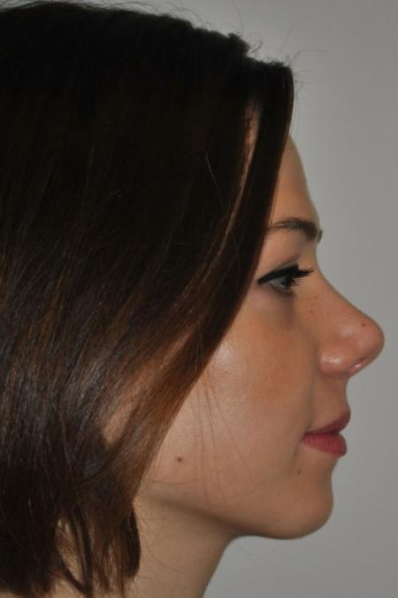 After image 4 Case #122616 - Aesthetic Reduction Rhinoplasty