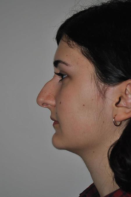 Before image 5 Case #122746 - Rhinoseptoplasty