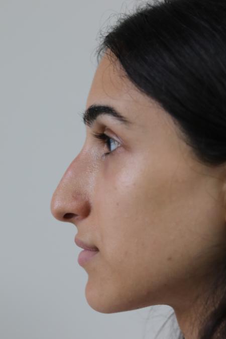 Before image 5 Case #122791 - Conventional Rhinoplasty