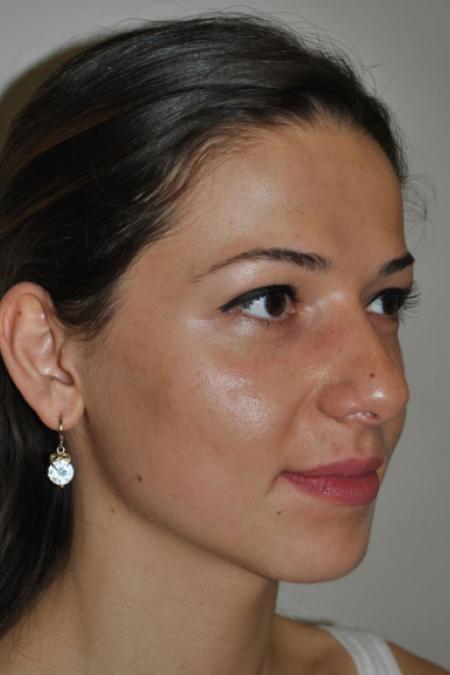 Before image 3 Case #122616 - Aesthetic Reduction Rhinoplasty