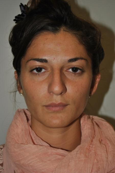 Before image 1 Case #122741 - Primary Rhinoseptoplasty, Turbinate Lateralization