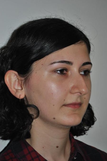 Before image 2 Case #122746 - Rhinoseptoplasty