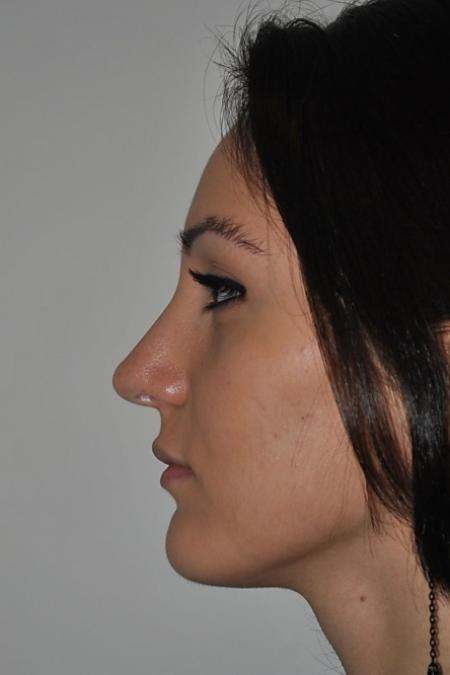 After image 5 Case #122611 - Aesthetic Reduction Rhinoseptoplasty