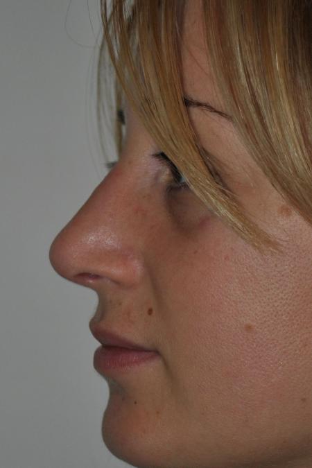 After image 5 Case #122796 - Aesthetic Reduction Conventional Rhinoseptoplasty