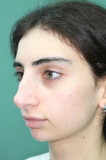 Before image 3 Case #122491 - Aesthetic Reduction Rhinoseptoplasty