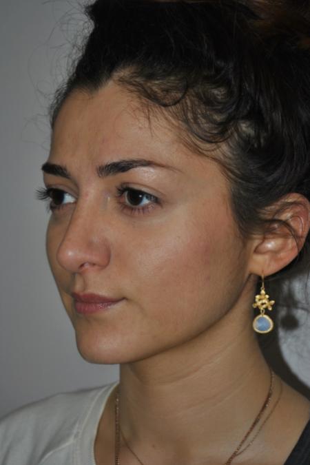 After image 3 Case #122741 - Primary Rhinoseptoplasty, Turbinate Lateralization