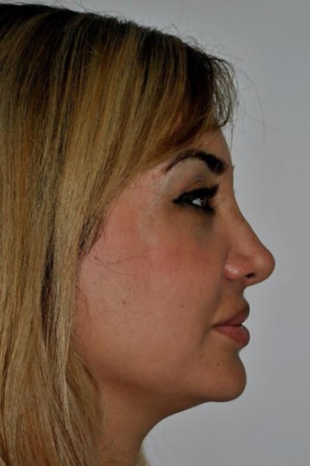 After image 4 Case #122601 - Aging Rhinoplasty