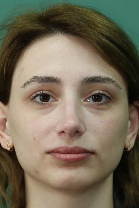 After image 1 Case #122881 - Deviation Syndrome. Rhinogenic Headache 