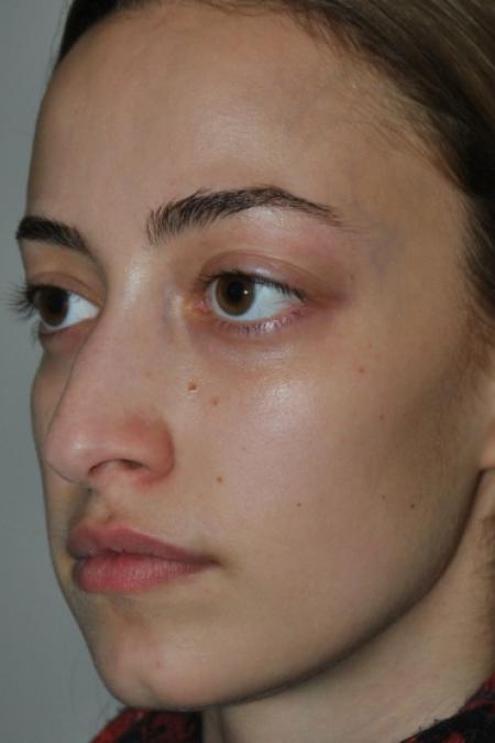 Before image 3 Case #122641 - Aesthetic Reduction Rhinoseptoplasty