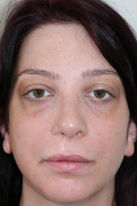 After image 1 Case #122581 - Cleft-Lip Nose Secondary Reconstruction