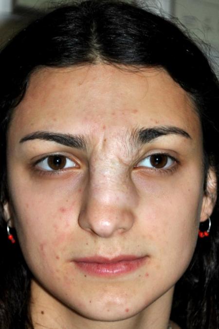 Before image 1 Case #122646 - Aestetic Reduction Rhinoplasty