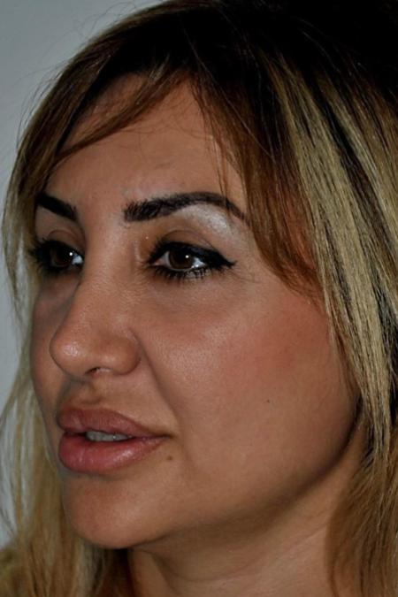 After image 3 Case #122601 - Aging Rhinoplasty