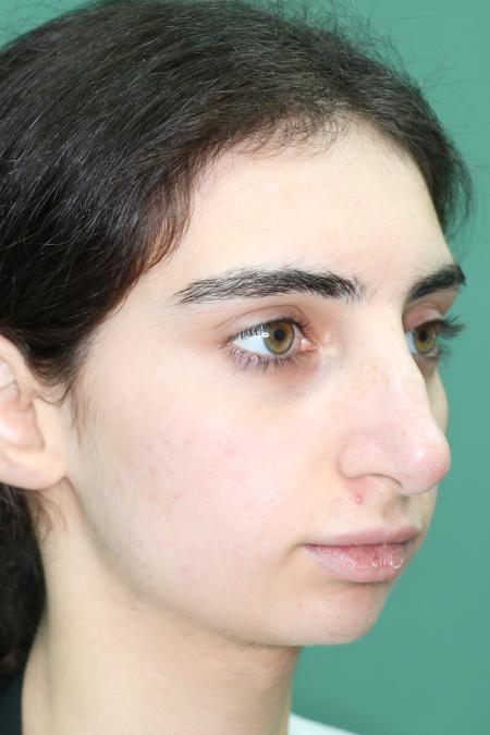 Before image 2 Case #122491 - Aesthetic Reduction Rhinoseptoplasty