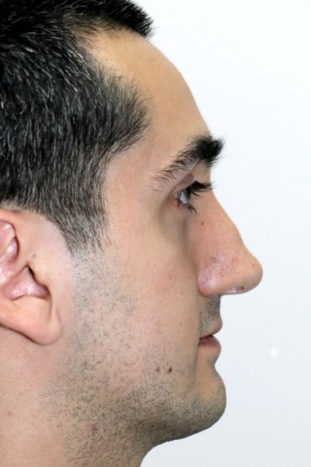 Before image 5 Case #122726 - Revision Rhinoseptoplasty, Turbinoplasty