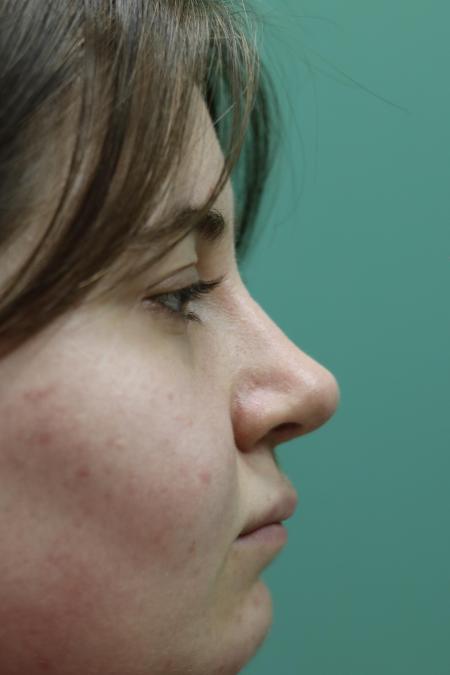 After image 4 Case #122866 - Nasal Deviation Syndrome
