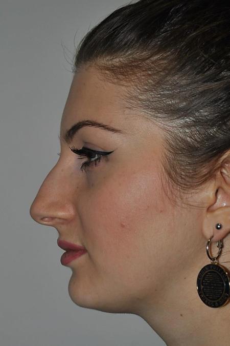 Before image 5 Case #122771 - Aesthetic Reduction Rhinoplasty