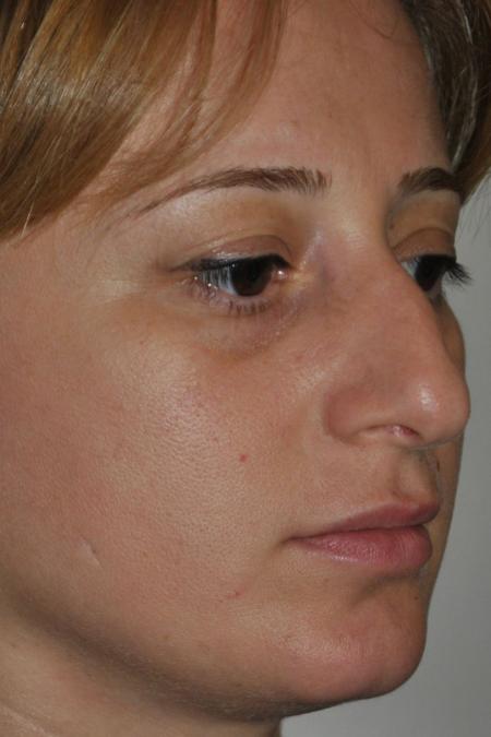 Before image 3 Case #122796 - Aesthetic Reduction Conventional Rhinoseptoplasty