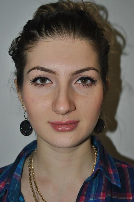 Before image 1 Case #122771 - Aesthetic Reduction Rhinoplasty