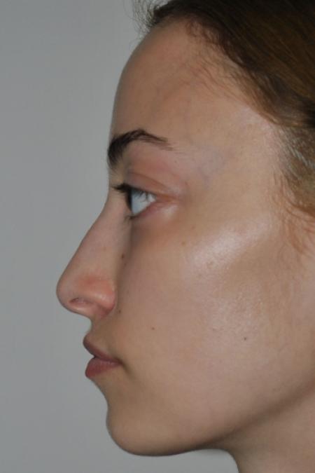 Before image 5 Case #122641 - Aesthetic Reduction Rhinoseptoplasty