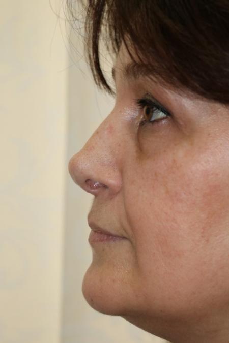 After image 4 Case #122596 - Aging Rhinoseptoplasty