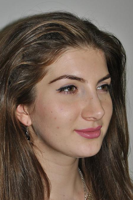 After image 2 Case #122771 - Aesthetic Reduction Rhinoplasty