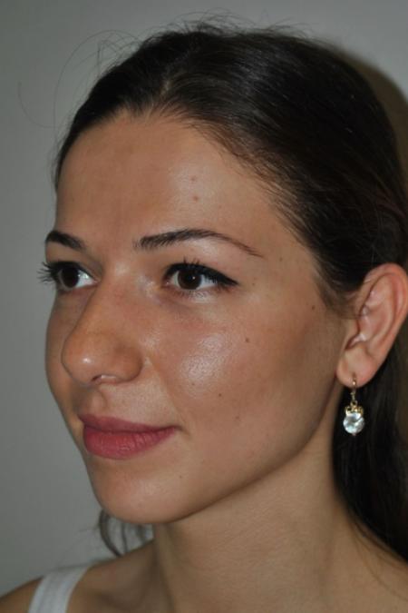 Before image 2 Case #122616 - Aesthetic Reduction Rhinoplasty