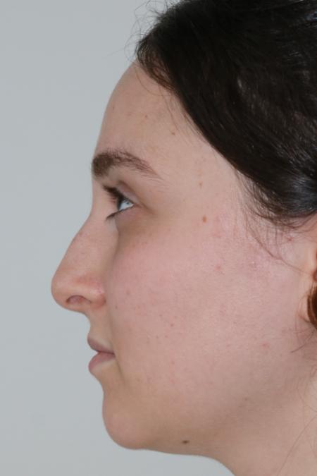 Before image 5 Case #122861 - Aesthetic Reduction Rhinoplasty