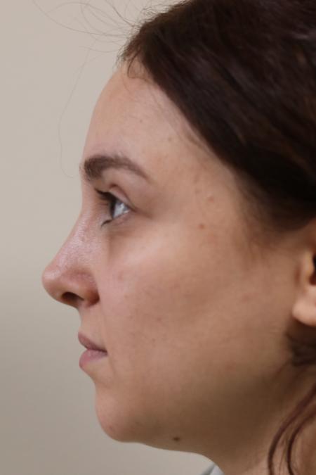 After image 5 Case #122861 - Aesthetic Reduction Rhinoplasty