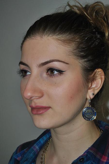 Before image 3 Case #122771 - Aesthetic Reduction Rhinoplasty