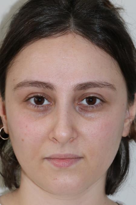 Before image 1 Case #122861 - Aesthetic Reduction Rhinoplasty