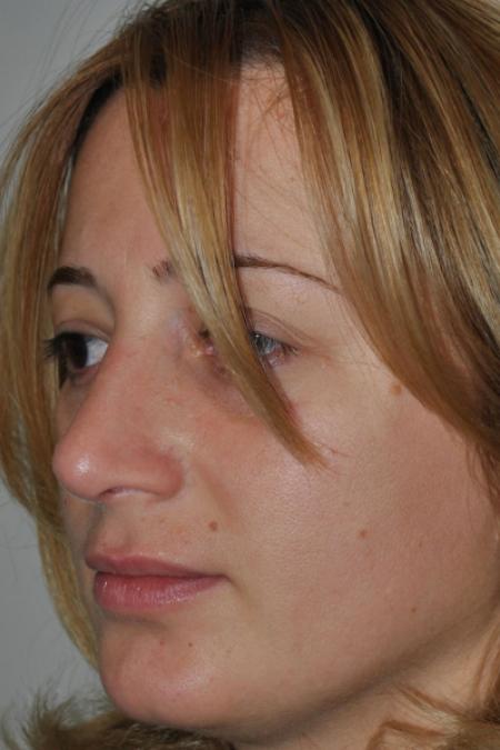 After image 2 Case #122796 - Aesthetic Reduction Conventional Rhinoseptoplasty