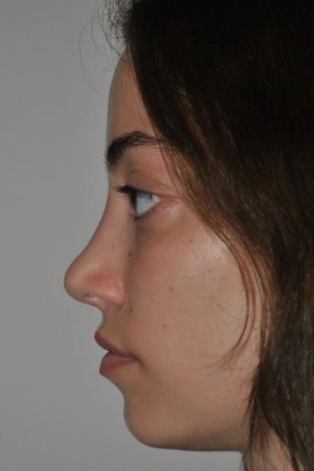 After image 5 Case #122641 - Aesthetic Reduction Rhinoseptoplasty