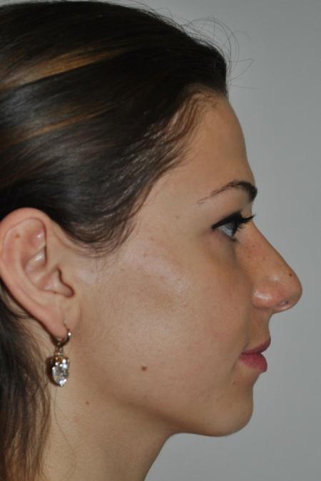 Before image 4 Case #122616 - Aesthetic Reduction Rhinoplasty