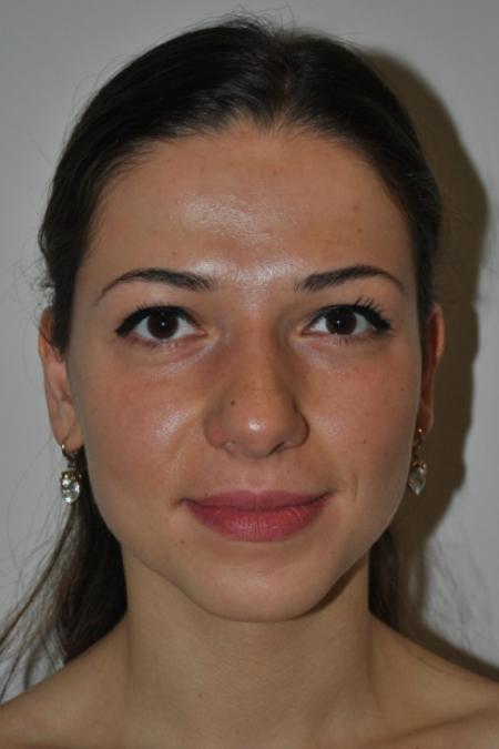 Before image 1 Case #122616 - Aesthetic Reduction Rhinoplasty